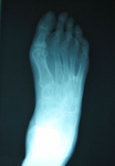 Don, Follow up thumbnail of an x-ray, Limb Lengthening, Foot Deformity Corrected, walking has greatly improved