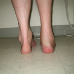 Don, Follow up thumbnail Image, Limb Lengthening, Foot Deformity Corrected, walking has greatly improved