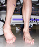Don, Pre-op thumbnail Image, Limb Lengthening, Foot Deformity Correction, Charcot-Marie-Tooth Disease 