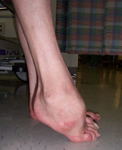 Don, Pre-op thumbnail Image, Limb Lengthening, Foot Deformity Correction, Charcot-Marie-Tooth Disease 
