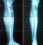 Graham, Follow up thumbnail of an x-ray image, Limb Lengthening, ankle and lengthening fully healed