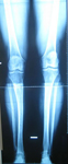 Graham, Follow up thumbnail of an x-ray image, Limb Lengthening, ankle and lengthening fully healed