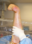 Claire, Pre Op thumbnail Images, Limb Lengthening, foot and ankle deformity, neuropathy