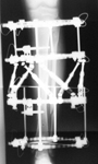 Tzvi, Post-op thumbnail of an X-ray, Limb Lengthening, ilizarov spatial frame, deformity correction