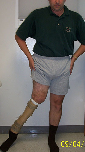 Image: Angelo with prosthesis