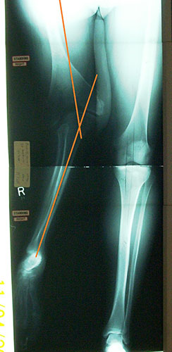 Image: XRay of Angelo's leg pre-surgery