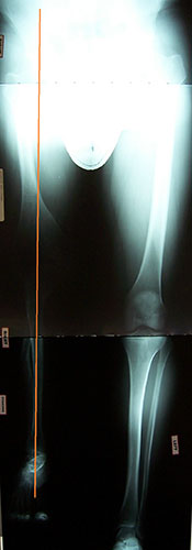 Image: XRay of Angelo's leg post surgery