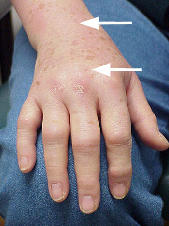 What’s Causing My Itchy Hands and Feet? - WebMD