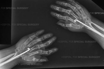 Post op X-ray of patient who has undergone arthrodesis of both wrists