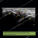 Image - Ultrasound of the Month Case 42 thumbnail