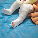 Photo of a baby being treated for club foot