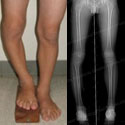 Before photo and after X-ray of growth plate deformity