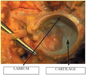 Labrum and cartilage of the hip socket from an article about hip arthroscopy