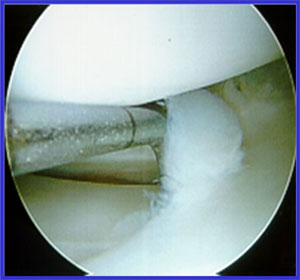 Arthroscopic photo showing meniscus tear.