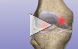 Graphic: Total knee replacement animation