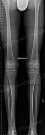 Postoperative X-ray demonstrating leg alignment
