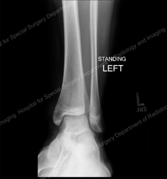 Image: X-ray showing the tibia after the fracture has healed and the screw has been removed