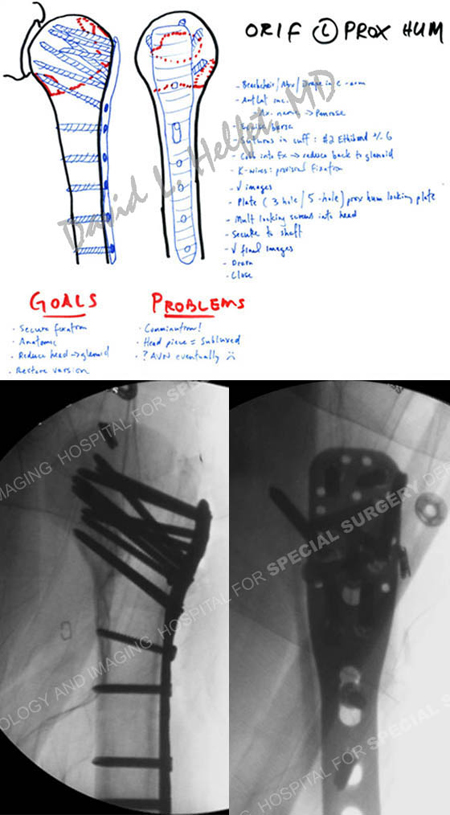preoperative plan and fluoroscopic images following humerus fracture surgery from a case example of shoulder fracture from the orthopedic trauma service at Hospital for Special Surgery.