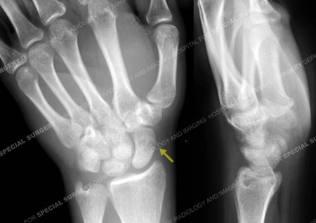 Radiograph revealing a scaphoid fracture from a case example of a hand fracture from Hospital for Special Surgery.