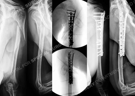 radiographs and fluoroscopic images of proximal humeral nonunion from a case example presented by the orthopedic trauma service at Hospital for Special Surgery.
