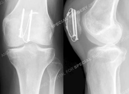 radiographs 13 months after surgery revealing a healed patella fracture from a case example presented by the orthopedic trauma service at Hospital for Special Surgery.