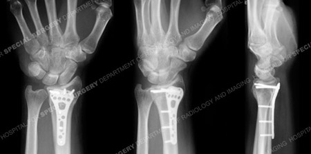 Radiograph at 6 months illustrates a healed distal radius fracture from a case example of a wrist fracture from the orthopedic trauma service at Hospital for Special Surgery.