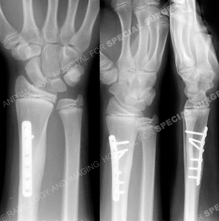 Radiographs at 8 months illustrating healed distal radius fracture from a case example presented by the orthopedic trauma service at Hospital for Special Surgery.