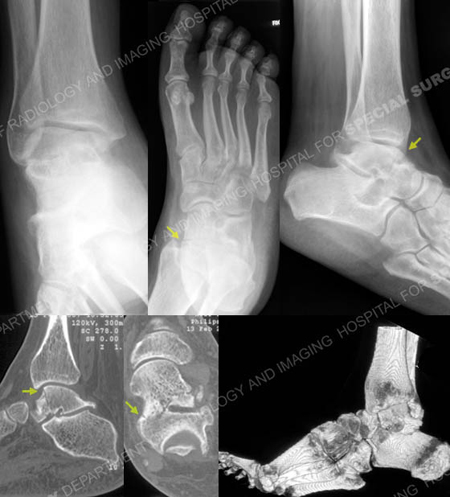 radiographs and ct scan revealing talus fracture from a case example presented by the orthopedic trauma service at Hospital for Special Surgery.