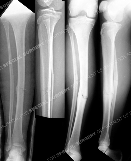 Radiographs revealing minimally displaced mid-shaft tibia stress fracture from a case example from the orthopedic trauma service at HSS.