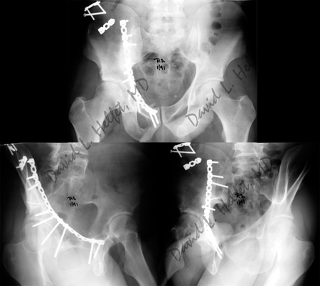 Radiographs two years following surgery of healed acetabular fracture from a case example presented by the orthopedic trauma service at hospital for special surgery.