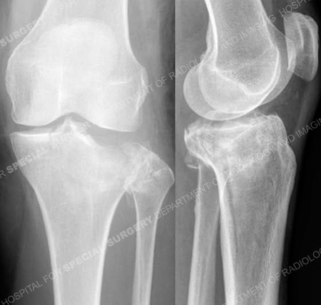 Radiographs revealing Schatzker II Tibial Plateau Fracture from a case example from the Orthopedic Trauma Service at Hospital for Special Surgery.