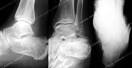 Radiograph revealing a calcaneus fracture from a Case Example of Foot Fractures from the Orthopedic Trauma Service at Hospital for Special Surgery.