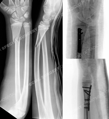 Radiographs reveal distal radius fracture from a case example presented by the orthopedic trauma service at Hospital for Special Surgery
