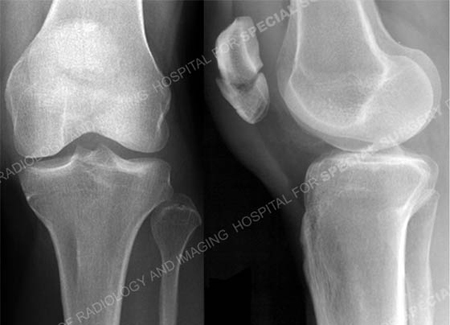 Radiographs revealing transverse patella fracture from a case example presented by the orhopedic trauma service at hospital for special surgery.