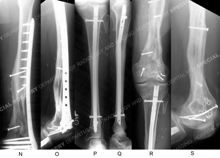 radiographs of healed distal femur fracture from case example presented hospital for special surgery's orthopedic trauma service