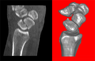 Sagittal reformatted computed tomography shows a fracture through the mid waist of the scaphoid