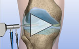 Graphic: Knee arthroscopy animation