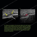 Image - Ultrasound of the Month Case 55 thumbnail