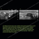 Image - Ultrasound of the Month Case 90 thumbnail