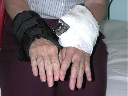 Image of a patient with external fixation frame in place