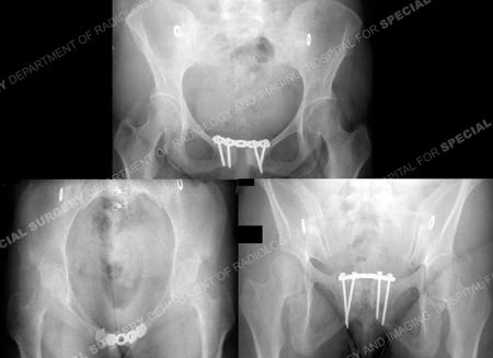 x-rays post-surgery of pelvis with hardware from case example presented by the orthopedic trauma service at Hospital for Special Surgery.