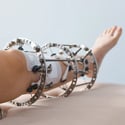Limb Lengthening Condition page