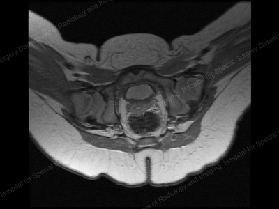 Image of relocated hip on MRI. Pediatric Hip Dysplasia
