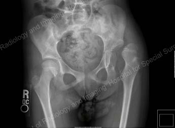 seven year-old girl with cerebral palsy, presenting with a dislocated left hip
