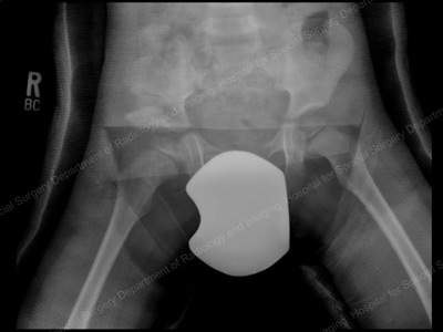 Immediate post-op image of pelvis and hip after Dega pelvic osteotomy. Pediatric Hip Dysplasia