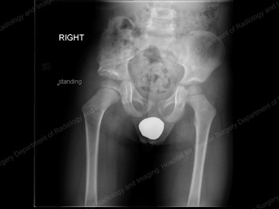 Final appearance of pelvis and hip 18 months after Dega pelvic osteotomy. Pediatric Hip Dysplasia