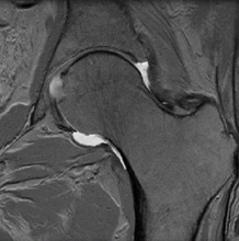 MRI of a normal hip with an intact labrum from an article about Femoroacetabular Impingement 