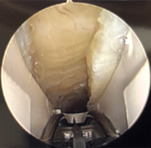 Endoscopic view of a cut transverse carpal ligament in carpal tunnel release surgery.