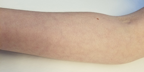 Livedo reticularis on the arm.