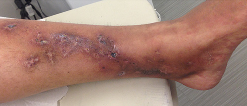 Patient with livedo vasculopathy, presenting with ulcerations of lower legs